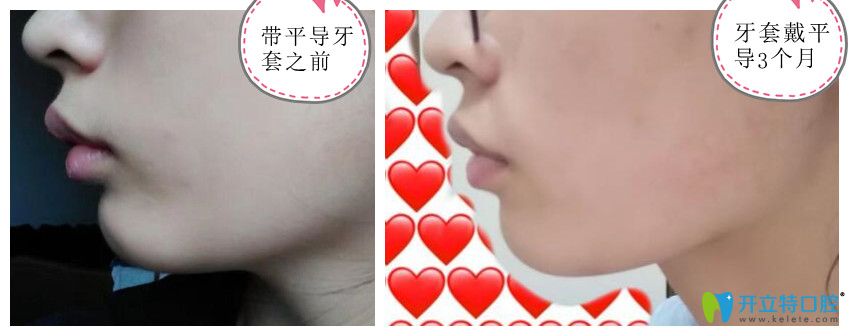 牙齒矯正戴平導(dǎo)3個月前后對比照