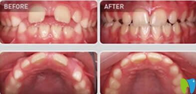 南昌安植雅口腔黃奇卿醫(yī)生兒童牙齒矯正案例 南昌安植雅口腔黃奇卿醫(yī)生兒童牙齒矯正案例