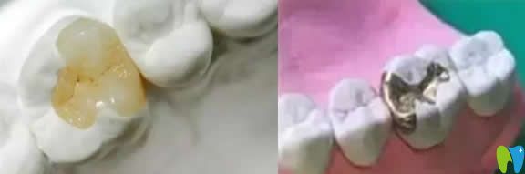 嵌體補牙后能用幾年?瓷嵌體/樹脂嵌體/金屬嵌體等區(qū)別在哪