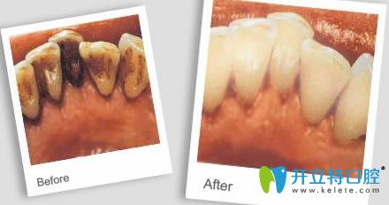 麗江錦美口腔朱錦鋒超聲波洗牙前后對(duì)比效果