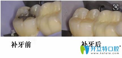 麗江錦美口腔3m z350樹(shù)脂補(bǔ)牙前后對(duì)比照