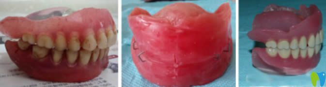 舌側集中頜排牙后的對比照片