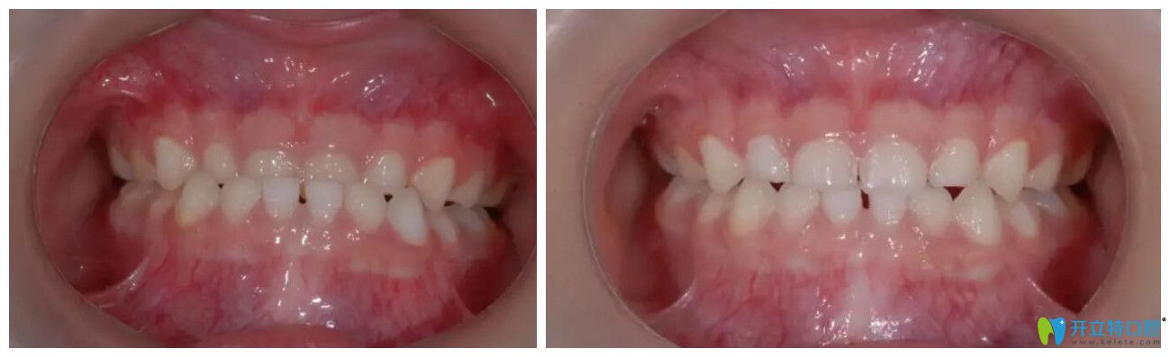 推簧矯正器矯正地包天前后對(duì)比圖