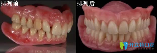 舌側集中頜全口義齒病例對比圖