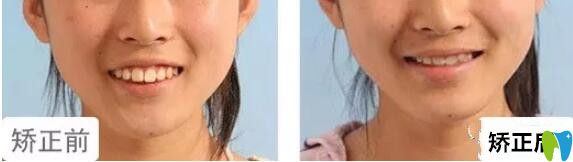 格倫菲爾口腔水平如何？14女孩上牙前突矯正<span style=