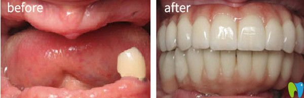 泰州北極星口腔怎么樣？看全口種植牙案例