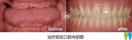 格倫菲爾口腔怎么樣？老年人全口牙缺失種植<span style=