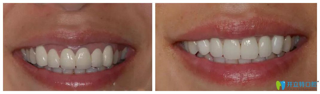 段銀鈴烤瓷牙失敗修復(fù)前后效果對比圖