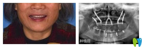 南京博韻口腔陳慧玲給林阿姨做穿顴骨種植牙術(shù)后照片