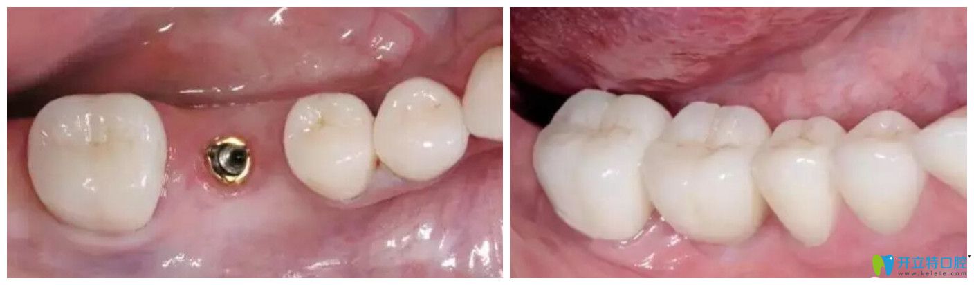 艾芳口腔段銀鈴單顆牙齒缺失種植案例效果前后對比