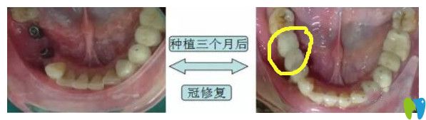 鵬博口腔種植牙案例 鵬博口腔種植牙案例