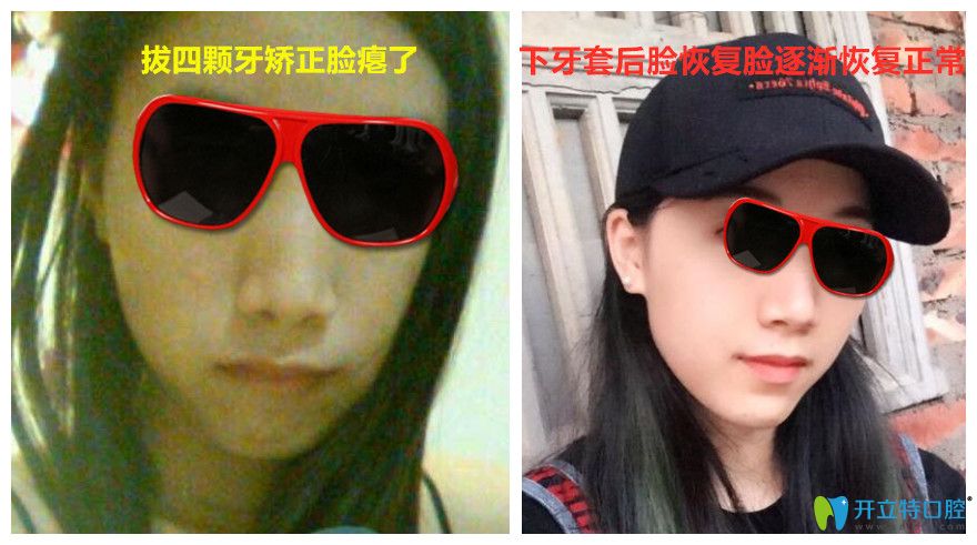 正畸過程拔牙后臉癟卸掉牙套后情況會(huì)好