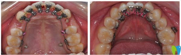 舌側(cè)隱形矯正前后療效圖