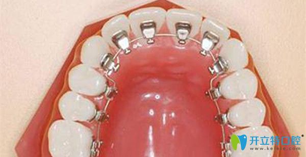 舌側(cè)保持器佩戴時間