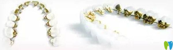 舌側(cè)保持器的優(yōu)缺點