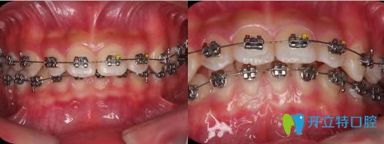 我在廈門康德佳口腔做牙齒矯正過程