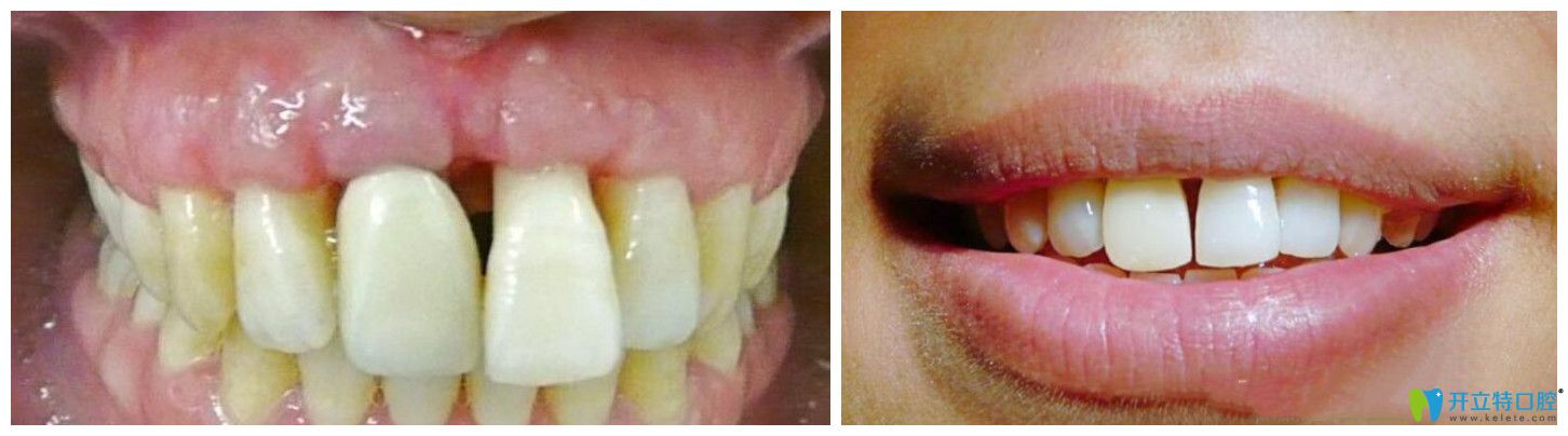 牙齦萎縮治療過程