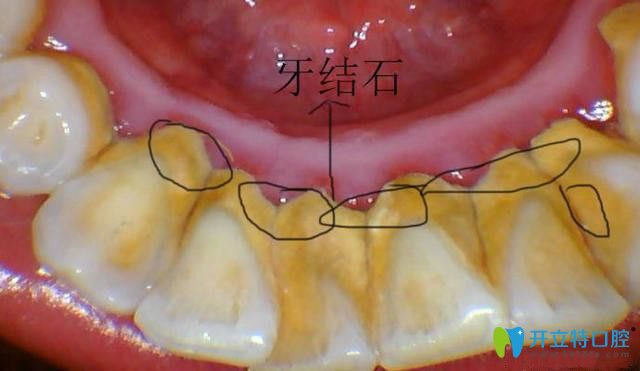 超聲波去牙結(jié)石