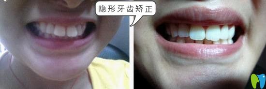 鵬博口腔門牙突出隱形矯正效果 鵬博口腔門牙突出隱形矯正效果