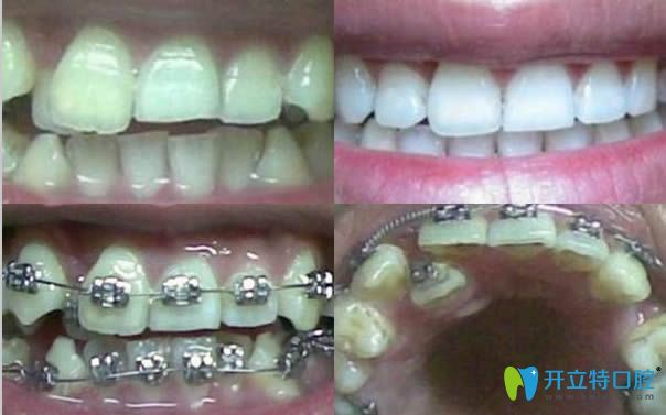 青島維樂口腔牙齒正畸效果對(duì)比圖