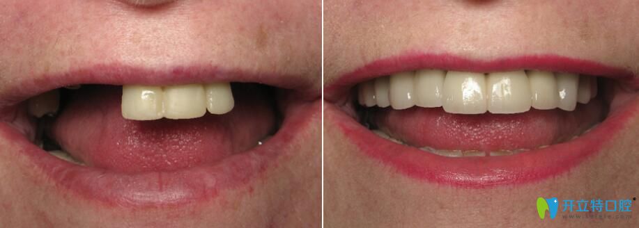松桃鵬博口腔微創(chuàng)種植牙前后對(duì)比效果 松桃鵬博口腔微創(chuàng)種植牙前后對(duì)比效果