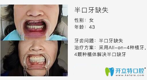 泰州北極星口腔徐雅軒醫(yī)生種植牙案例 泰州北極星口腔徐雅軒醫(yī)生種植牙案例