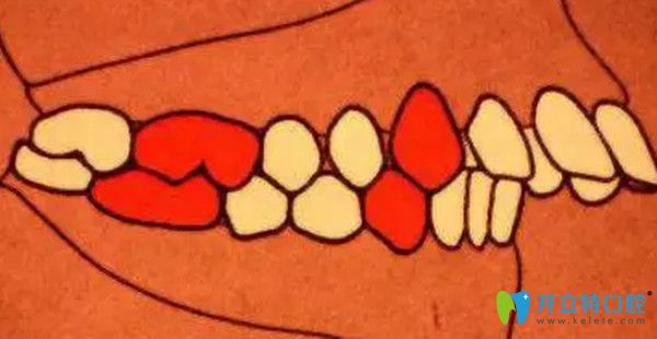 安氏二類錯頜  遠(yuǎn)中錯頜  頭一個分類