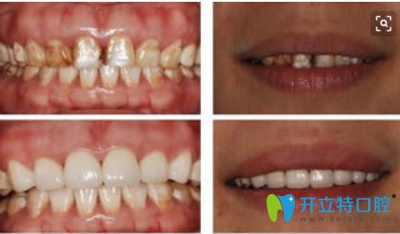 重度氟斑牙選擇美容冠后的對比效果圖 重度氟斑牙選擇美容冠后的對比效果圖