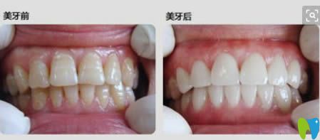 輕度氟斑牙選擇冷光美白后的對比效果 輕度氟斑牙選擇冷光美白后的對比效果