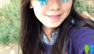 骨性下頜偏斜掩飾性正畸后正頜