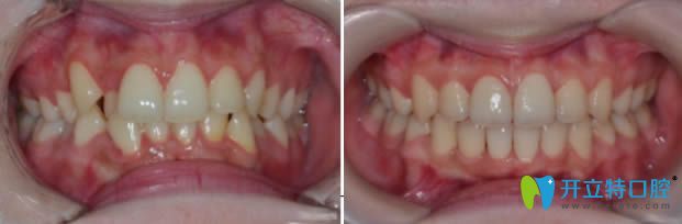 麗江錦美口腔成人牙齒擁擠不齊矯正案例效果 麗江錦美口腔成人牙齒擁擠不齊矯正案例效果