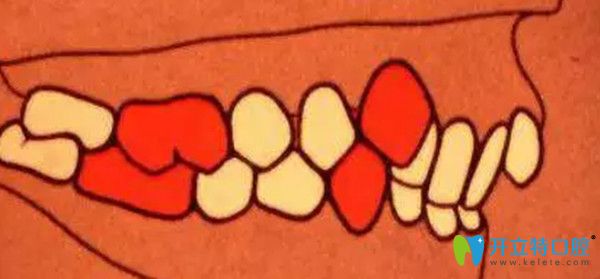 安氏二類錯頜  遠(yuǎn)中錯頜  第2分類