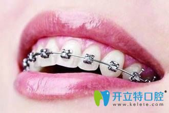 牙醫(yī)否定矯正牙齒老了會容易掉牙，原因在此