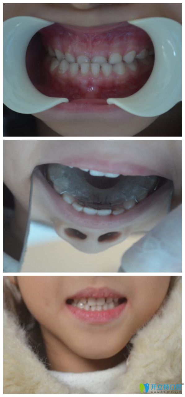 牙齒活動(dòng)矯正器有效果嗎