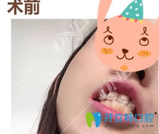 廣州壹加壹口腔 我在廣州壹加壹矯正前牙反頜120天 牙齒整齊了下巴也出來(lái)了