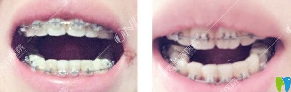 牙齒矯正第二個(gè)月變化圖