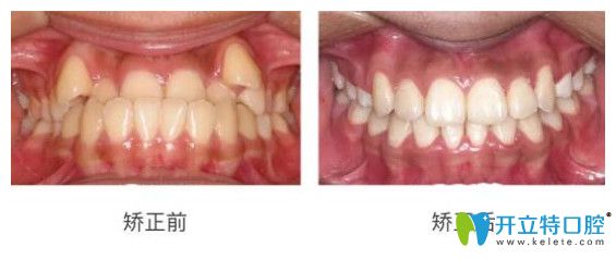 淄博海全口腔潘海全醫(yī)生兒童反頜矯正案例效果 淄博海全口腔潘海全醫(yī)生兒童反頜矯正案例效果