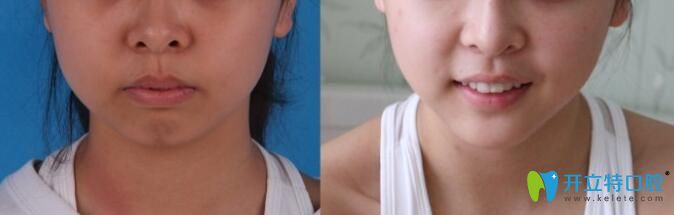 上牙包住下牙矯正前后對比圖