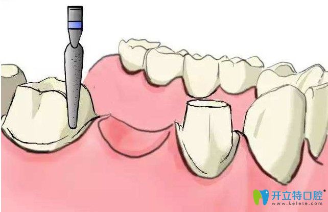 肖勇昌院長(zhǎng)解析關(guān)于種植牙的知識(shí)
