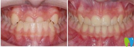 昆明德韓口腔李琳娜醫(yī)生青少年地包天矯正案例