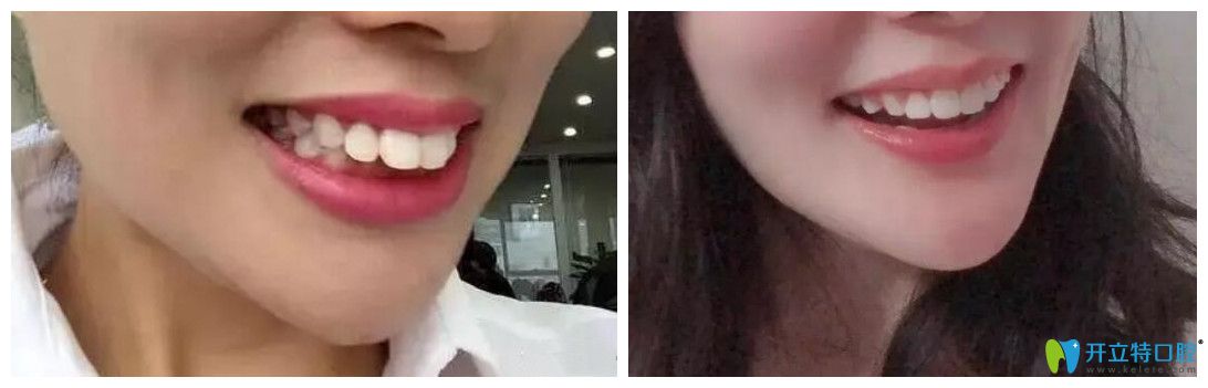 牙齒外翻矯正耗時快3年，才終于取得成效