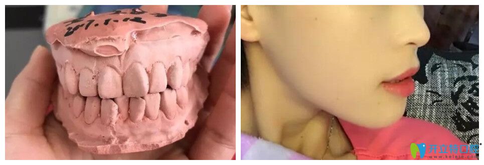 這不僅有上牙外翻圖片，還有上牙外翻矯正的方法及價(jià)格