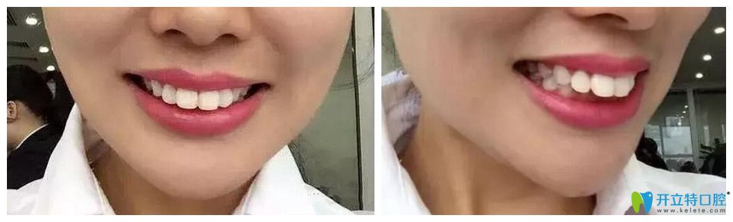 上牙外翻情況比較嚴(yán)重