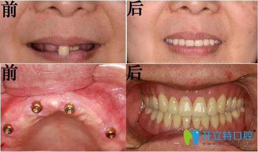 東莞好佰年口腔allon6全口種植牙真實案例