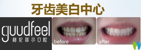 深圳格倫菲爾牙齒美白前后對比