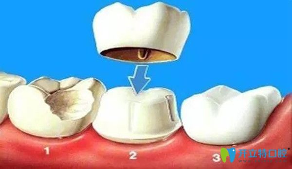 做完牙冠修復(fù)后悔了，牙冠修復(fù)的意義何在？