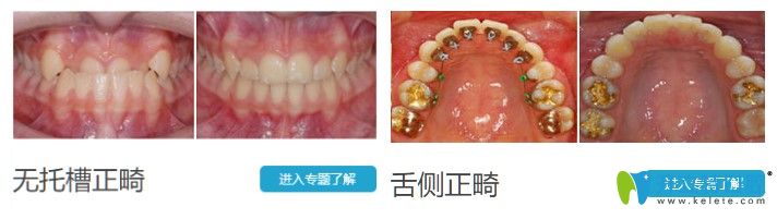 昆明德韓口腔青少年地包天矯正前后對比照