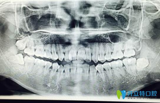 90后自述門牙牙根短做矯正感受