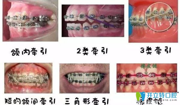 矯正中你所了解的橡皮筋的作用 矯正中你所了解的橡皮筋的作用