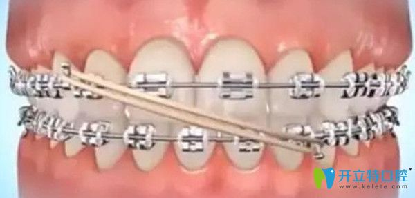 矯正中哪個(gè)階段需要佩戴橡皮圈 矯正中哪個(gè)階段需要佩戴橡皮圈